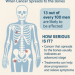 Bone Metastasis