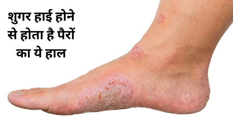 डायबिटीज
